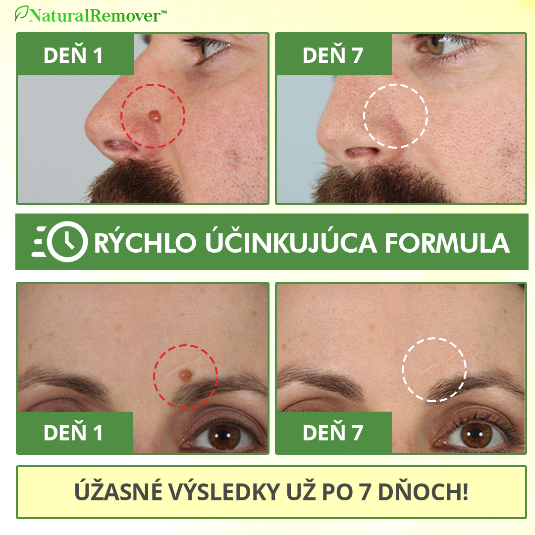 NaturalRemover™ Odstraňovač Bradavíc